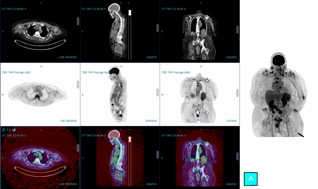 TEP/TDM 18F-FDG avec endocardite et spondylodiscite